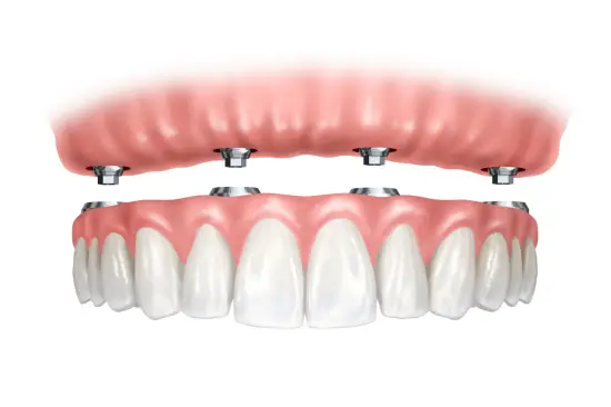 Implantáció Implantáció